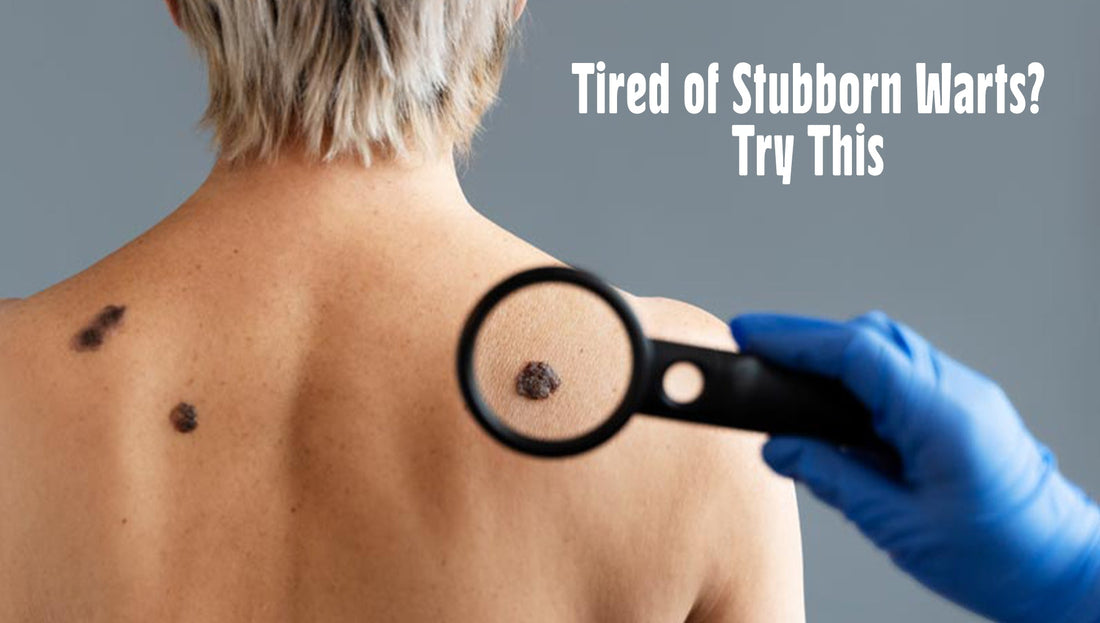Struggling with Stubborn Warts? Here’s the Solution That Works