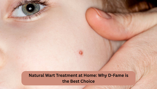 Natural Wart Treatment at Home: Why D-Fame is the Best Choice