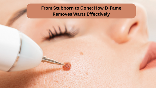 From Stubborn to Gone: How D-Fame Removes Warts Effectively