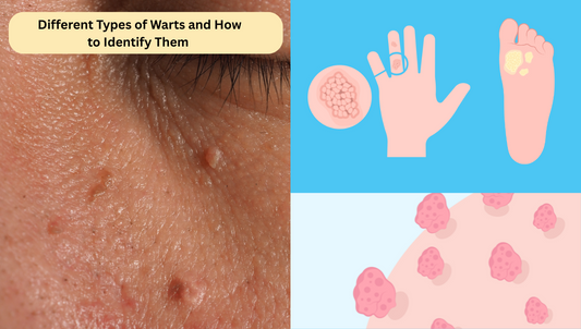 Different Types of Warts and How to Identify Them