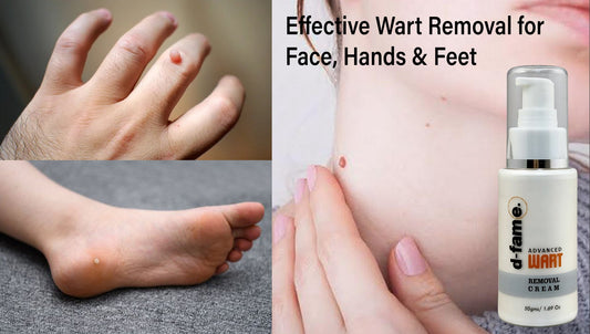 Best Wart Removal Cream for Face, Hands & Feet