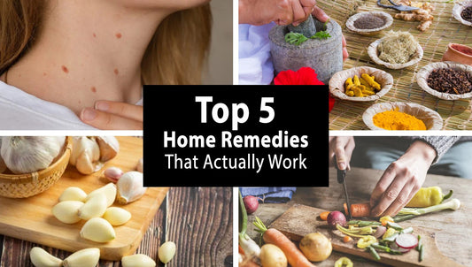 Say Goodbye to Skin Warts Naturally: Top 5 Home Remedies That Actually Work