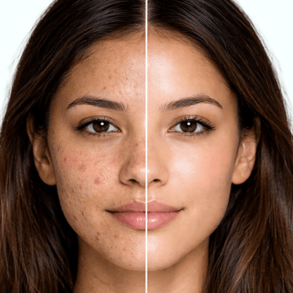 D-Fame Pimple & Anti-Acne Serum – Clear Skin, Oil Control & Spot Reduction